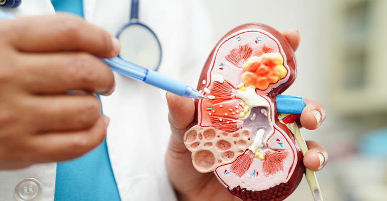 4 de cada 10 pacientes diagnosticados con diabetes y atendidos por Endocrinología en España tienen enfermedad renal crónica (ERC)